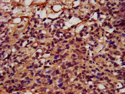IHC image of FATE1 Antibody diluted at 1:400 and staining in paraffin-embedded human ovarian cancer performed on a Leica BondTM system. After dewaxing and hydration, antigen retrieval was mediated by high pressure in a citrate buffer (pH 6.0). Section was blocked with 10% normal goat serum 30min at RT. Then primary antibody (1% BSA) was incubated at 4°C overnight. The primary is detected by a biotinylated secondary antibody and visualized using an HRP conjugated SP system.Rabbit anti-Human FATE1 Polyclonal Antibody