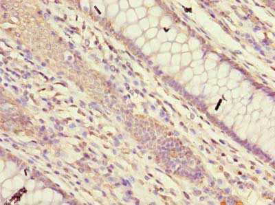 Immunohistochemistry of paraffin-embedded human colon cancer using FAM149B1 Antibody at dilution of 1:100Rabbit anti-Human FAM149B1 Polyclonal Antibody