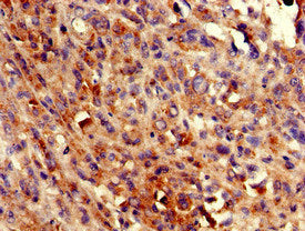 Immunohistochemistry of paraffin-embedded human melanoma using COQ8B Antibody at dilution of 1:100Rabbit anti-Human COQ8B Polyclonal Antibody