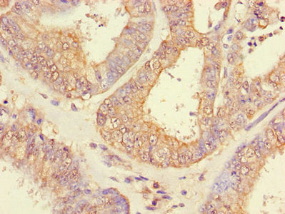 Immunohistochemistry of paraffin-embedded human endometrial cancer using CHFR Antibody at dilution of 1:100Rabbit anti-Human CHFR Polyclonal Antibody