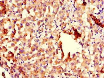 Immunohistochemistry of paraffin-embedded human lung cancer using CHFR Antibody at dilution of 1:100Rabbit anti-Human CHFR Polyclonal Antibody