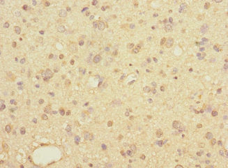 Immunohistochemistry of paraffin-embedded human glioma using LINGO1 Antibody at dilution of 1:100