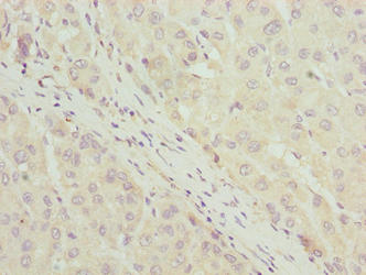 Immunohistochemistry of paraffin-embedded human liver cancer using LLCFC1 Antibody at dilution of 1:100