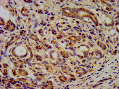 IHC image of KIF20B Antibody diluted at 1:400 and staining in paraffin-embedded human pancreatic cancer performed on a Leica BondTM system. After dewaxing and hydration, antigen retrieval was mediated by high pressure in a citrate buffer (pH 6.0). Section was blocked with 10% normal goat serum 30min at RT. Then primary antibody (1% BSA) was incubated at 4°C overnight. The primary is detected by a biotinylated secondary antibody and visualized using an HRP conjugated SP system.