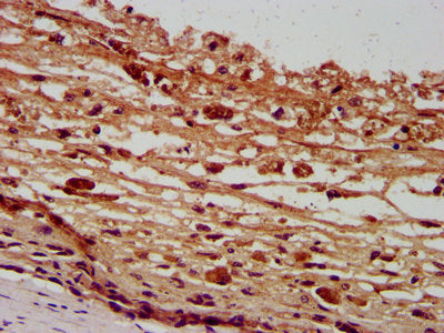 IHC image of PANX2 Antibody diluted at 1:400 and staining in paraffin-embedded human melanoma performed on a Leica BondTM system. After dewaxing and hydration, antigen retrieval was mediated by high pressure in a citrate buffer (pH 6.0). Section was blocked with 10% normal goat serum 30min at RT. Then primary antibody (1% BSA) was incubated at 4°C overnight. The primary is detected by a biotinylated secondary antibody and visualized using an HRP conjugated SP system.Rabbit anti-Human PANX2 Polyclonal Antibody