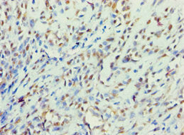 Immunohistochemistry of paraffin-embedded human breast cancer using BBS4 Antibody at dilution of 1:100