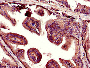 Immunohistochemistry of paraffin-embedded human prostate tissue using UHMK1 Antibody at dilution of 1:100Rabbit anti-Human UHMK1 Polyclonal Antibody