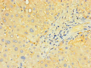 Immunohistochemistry of paraffin-embedded human liver tissue using SLC25A40 Antibody at dilution of 1:100Rabbit anti-Human SLC25A40 Polyclonal Antibody