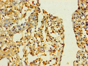 Immunohistochemistry of paraffin-embedded human bladder cancer using SLC25A40 Antibody at dilution of 1:100Rabbit anti-Human SLC25A40 Polyclonal Antibody