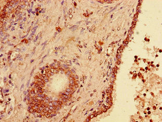 Immunohistochemistry of paraffin-embedded human prostate cancer using USP33 Antibody at dilution of 1:100Rabbit anti-Human USP33 Polyclonal Antibody