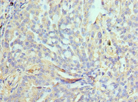 Immunohistochemistry of paraffin-embedded human lung cancer using NPRL2 Antibody at dilution of 1:100Rabbit anti-Human NPRL2 Polyclonal Antibody