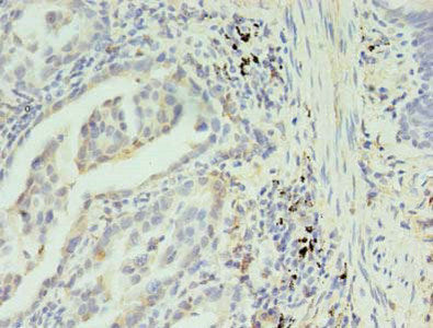 Immunohistochemistry of paraffin-embedded human lung cancer using SLC35F5 Antibody at dilution of 1:100Rabbit anti-Human SLC35F5 Polyclonal Antibody