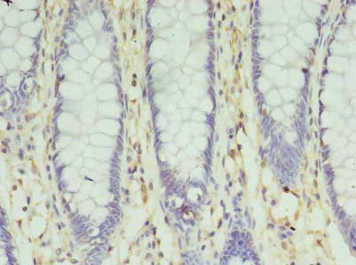 Immunohistochemistry of paraffin-embedded human colon cancer using SLC35F5 Antibody at dilution of 1:100Rabbit anti-Human SLC35F5 Polyclonal Antibody