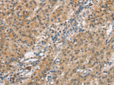 The image on the left is immunohistochemistry of paraffin-embedded Human gastric cancer tissue using SMAD1 Antibody(SMAD1 Antibody) at dilution 1/40, on the right is treated with synthetic peptide. (Original magnification: ×200)Rabbit anti-Human SMAD1 Polyclonal Antibody