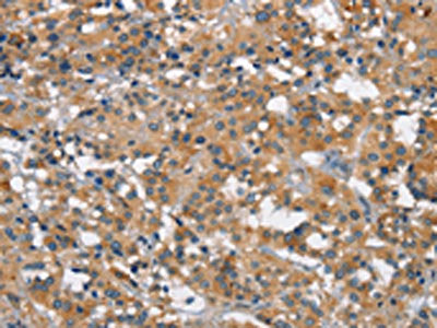 The image on the left is immunohistochemistry of paraffin-embedded Human thyroid cancer tissue using the antibody Antibody) at dilution 1/40, on the right is treated with synthetic peptide. (Original magnification: ×200)Rabbit anti-Human SMAD1 Polyclonal Antibody