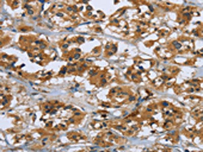 The image on the left is immunohistochemistry of paraffin-embedded Human thyroid cancer tissue using the antibody Antibody) at dilution 1/50, on the right is treated with fusion protein. (Original magnification: ×200)Rabbit anti-Human RAP1B Polyclonal Antibody