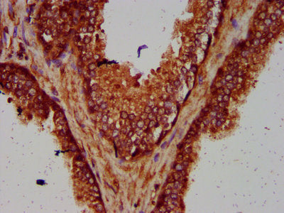 IHC image of the antibody diluted at 1:600 and staining in paraffin-embedded human prostate cancer performed on a Leica BondTM system. After dewaxing and hydration, antigen retrieval was mediated by high pressure in a citrate buffer (pH 6.0). Section was blocked with 10% normal goat serum 30min at RT. Then primary antibody (1% BSA) was incubated at 4°C overnight. The primary is detected by a biotinylated secondary antibody and visualized using an HRP conjugated SP system.Rabbit anti-Human SMG7 Polyclonal Antibody