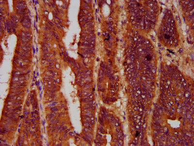 IHC image of SMG7 Antibody diluted at 1:600 and staining in paraffin-embedded human colon cancer performed on a Leica BondTM system. After dewaxing and hydration, antigen retrieval was mediated by high pressure in a citrate buffer (pH 6.0). Section was blocked with 10% normal goat serum 30min at RT. Then primary antibody (1% BSA) was incubated at 4°C overnight. The primary is detected by a biotinylated secondary antibody and visualized using an HRP conjugated SP system.Rabbit anti-Human SMG7 Polyclonal Antibody