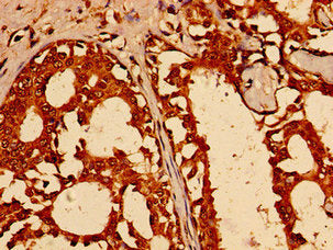 Immunohistochemistry of paraffin-embedded human breast cancer using the antibody at dilution of 1:100Rabbit anti-Human TFAP2C Polyclonal Antibody