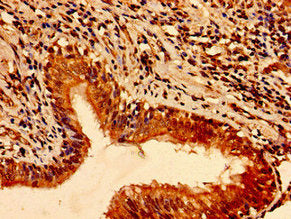 Immunohistochemistry of paraffin-embedded human lung cancer using TFAP2C Antibody at dilution of 1:100Rabbit anti-Human TFAP2C Polyclonal Antibody