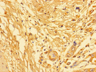 Immunohistochemistry of paraffin-embedded human pancreatic cancer using KLK6 Antibody at dilution of 1:100