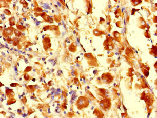 Immunohistochemistry of paraffin-embedded human melanoma using the antibody at dilution of 1:100Rabbit anti-Human CDS1 Polyclonal Antibody
