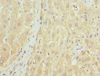 Immunohistochemistry of paraffin-embedded human liver tissue using HGD Antibody at dilution of 1:100Rabbit anti-Human HGD Polyclonal Antibody