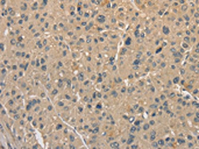 The image on the left is immunohistochemistry of paraffin-embedded Human liver cancer tissue using the antibody Antibody) at dilution 1/40, on the right is treated with fusion protein. (Original magnification: ×200)Rabbit anti-Human ALDH8A1 Polyclonal Antibody