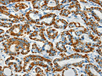 The image on the left is immunohistochemistry of paraffin-embedded Human thyroid cancer tissue using BCAT2 Antibody(BCAT2 Antibody) at dilution 1/70, on the right is treated with fusion protein. (Original magnification: ×200)