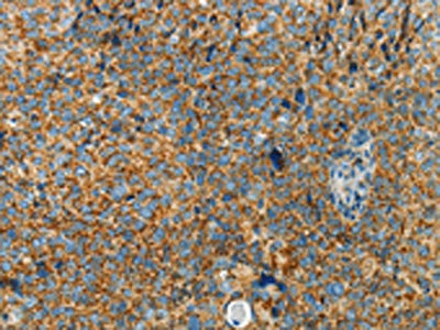 The image on the left is immunohistochemistry of paraffin-embedded Human cervical cancer tissue using the antibody Antibody) at dilution 1/70, on the right is treated with fusion protein. (Original magnification: ×200)