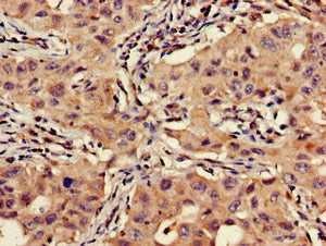 Immunohistochemistry of paraffin-embedded human lung cancer using VTI1A Antibody at dilution of 1:100Rabbit anti-Human VTI1A Polyclonal Antibody