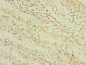 Immunohistochemistry of paraffin-embedded human gastric cancer using DHTKD1 Antibody at dilution of 1:100Rabbit anti-Human DHTKD1 Polyclonal Antibody