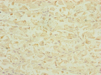 Immunohistochemistry of paraffin-embedded human gastric cancer using DHTKD1 Antibody at dilution of 1:100Rabbit anti-Human DHTKD1 Polyclonal Antibody