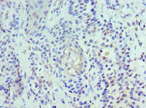 Immunohistochemistry of paraffin-embedded human breast cancer using UBE2J2 Antibody at dilution of 1:100Rabbit anti-Human UBE2J2 Polyclonal Antibody