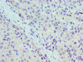 Immunohistochemistry of paraffin-embedded human liver cancer using UBE2J2 Antibody at dilution of 1:100Rabbit anti-Human UBE2J2 Polyclonal Antibody