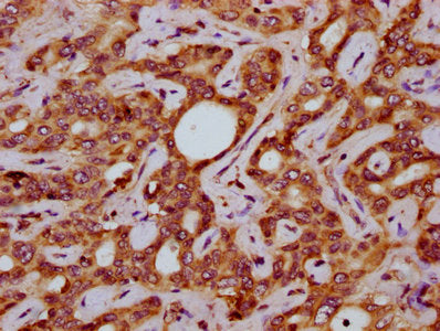 IHC image of the antibody diluted at 1:200 and staining in paraffin-embedded human liver cancer performed on a Leica BondTM system. After dewaxing and hydration, antigen retrieval was mediated by high pressure in a citrate buffer (pH 6.0). Section was blocked with 10% normal goat serum 30min at RT. Then primary antibody (1% BSA) was incubated at 4°C overnight. The primary is detected by a biotinylated secondary antibody and visualized using an HRP conjugated SP system.Rabbit anti-Human SLC15A4 Polyclonal Antibody