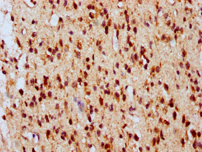 IHC image of ATG16L2 Antibody diluted at 1:700 and staining in paraffin-embedded human glioma performed on a Leica BondTM system. After dewaxing and hydration, antigen retrieval was mediated by high pressure in a citrate buffer (pH 6.0). Section was blocked with 10% normal goat serum 30min at RT. Then primary antibody (1% BSA) was incubated at 4°C overnight. The primary is detected by a biotinylated secondary antibody and visualized using an HRP conjugated SP system.Rabbit anti-Human ATG16L2 Polyclonal Antibody