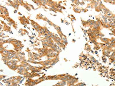 The image on the left is immunohistochemistry of paraffin-embedded Human gastric cancer tissue using RARRES1 Antibody(RARRES1 Antibody) at dilution 1/60, on the right is treated with synthetic peptide. (Original magnification: ×200)Rabbit anti-Human RARRES1 Polyclonal Antibody