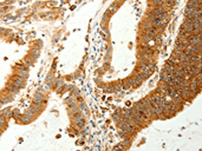 The image on the left is immunohistochemistry of paraffin-embedded Human colon cancer tissue using the antibody Antibody) at dilution 1/60, on the right is treated with synthetic peptide. (Original magnification: ×200)Rabbit anti-Human RARRES1 Polyclonal Antibody
