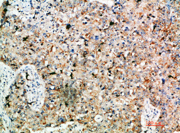 Immunohistochemical analysis of paraffin-embedded human-lung-cancer, antibody was diluted at 1:200