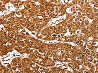 The image on the left is immunohistochemistry of paraffin-embedded Human lung cancer tissue using SMARCA4 Antibody(SMARCA4 Antibody) at dilution 1/50, on the right is treated with synthetic peptide. (Original magnification: ×200)Rabbit anti-Human SMARCA4 Polyclonal Antibody