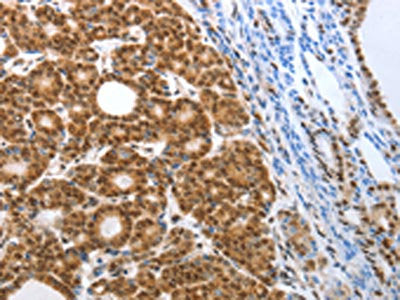 The image on the left is immunohistochemistry of paraffin-embedded Human thyroid cancer tissue using the antibody Antibody) at dilution 1/50, on the right is treated with synthetic peptide. (Original magnification: ×200)Rabbit anti-Human SMARCA4 Polyclonal Antibody