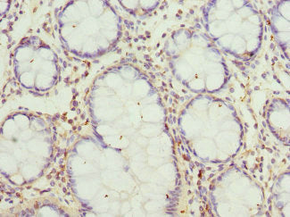 Immunohistochemistry of paraffin-embedded human colon cancer using GCNT2 Antibody at dilution of 1:100Rabbit anti-Human GCNT2 Polyclonal Antibody