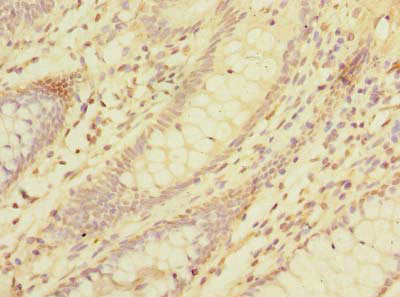 Immunohistochemistry of paraffin-embedded human colon cancer using LMO3 Antibody at dilution of 1:100