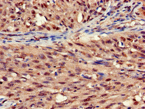 Immunohistochemistry of paraffin-embedded human lung cancer using STOML3 Antibody at dilution of 1:100Rabbit anti-Human STOML3 Polyclonal Antibody