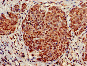 Immunohistochemistry of paraffin-embedded human ovarian cancer using STOML3 Antibody at dilution of 1:100Rabbit anti-Human STOML3 Polyclonal Antibody