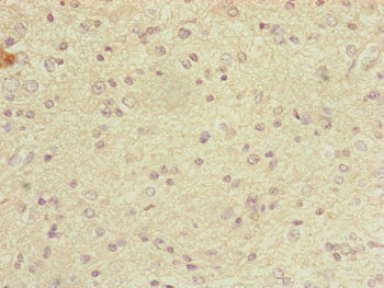 Immunohistochemistry of paraffin-embedded human glioma using DYNC2LI1 Antibody at dilution of 1:100Rabbit anti-Human DYNC2LI1 Polyclonal Antibody