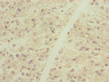Immunohistochemistry of paraffin-embedded human glioma using DYNC2LI1 Antibody at dilution of 1:100Rabbit anti-Human DYNC2LI1 Polyclonal Antibody