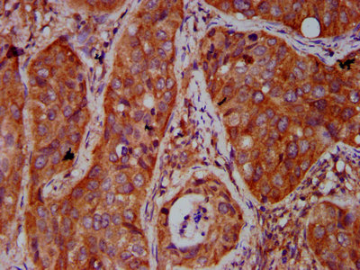 IHC image of BICD2 Antibody diluted at 1:500 and staining in paraffin-embedded human cervical cancer performed on a Leica BondTM system. After dewaxing and hydration, antigen retrieval was mediated by high pressure in a citrate buffer (pH 6.0). Section was blocked with 10% normal goat serum 30min at RT. Then primary antibody (1% BSA) was incubated at 4°C overnight. The primary is detected by a biotinylated secondary antibody and visualized using an HRP conjugated SP system.