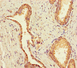 Immunohistochemistry of paraffin-embedded human prostate cancer using UBE2Q2 Antibody at dilution of 1:100Rabbit anti-Human UBE2Q2 Polyclonal Antibody